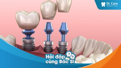 Lưu ý khi tham khảo giá trồng răng Implant tại các nha khoa tại TP.HCM