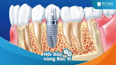 Vì sao trụ Implant có thể khắc phục được tình trạng tiêu xương răng?