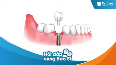 Mất nhiều răng liền kề thì nên trồng trụ Implant như thế nào?