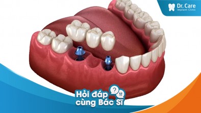 Mất răng vị trí trong cùng ở hàm dưới, có trồng được trụ Implant không?