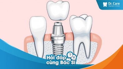 Trồng răng Implant có phù hợp với mọi đối tượng không?