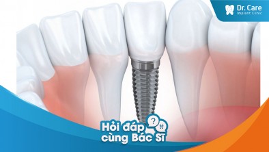 Thời gian hoàn thành lộ trình điều trị trồng răng Implant đơn lẻ mất bao lâu?