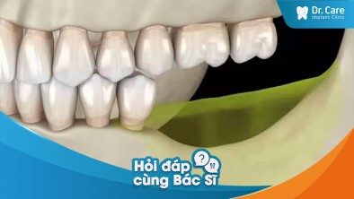 Đối với tình trạng bị tiêu xương hàm nặng, thời gian trồng răng Implant có kéo dài không?