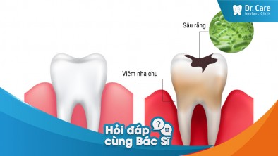 Bị sâu răng có kéo dài thời gian trồng răng Implant không?