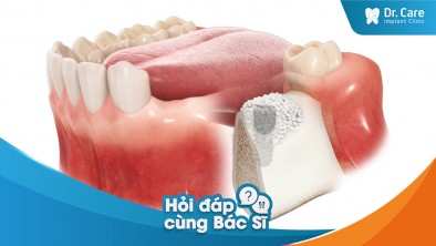 Đối tượng nào cần phải ghép xương trước khi thực hiện trồng răng Implant?