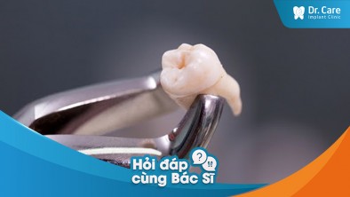 Theo bác sĩ thì sau khi nhổ răng bao lâu thì nên trồng răng Implant?