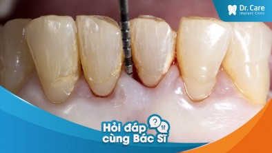 Không điều trị viêm nha chu trước khi trồng răng Implant có bị ảnh hưởng gì không?