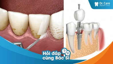 Làm sao để xác định liệu viêm nha chu đã được điều trị thành công hay chưa trước khi trồng răng Implant?