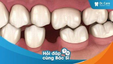 Trong trường hợp mất răng lâu năm, có thể trồng trụ Implant Hàn Quốc ngay sau khi tháo răng cũ không?