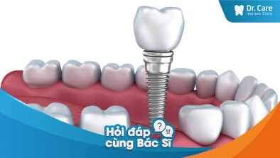Mất răng lâu năm có thể gây ra hậu quả nghiêm trọng khác cho răng miệng không? Trụ Implant Hàn Quốc có thể giúp ngăn ngừa những vấn đề này không?