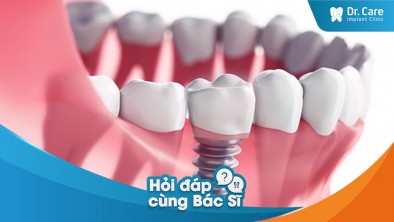 Mất răng trong một thời gian dài, liệu tôi có thể trồng trụ Implant Hàn Quốc để khôi phục chức năng răng miệng không?