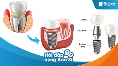 Cấy ghép Implant có khôi phục lại được chức năng của răng và ngoại hình như ban đầu ở vùng mất răng do nha chu không?