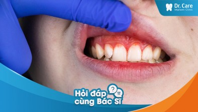 Bị mất răng do viêm nha chu, làm sao để ngăn ngừa tình trạng lây lan sang các răng khác và giải pháp phục hồi răng bị mất?