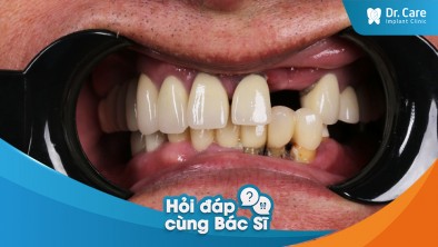 Sau khi sử dụng cầu răng sứ lâu năm, bị tình trạng viêm nha chu, giải pháp trồng răng Implant có khắc phục được tình trạng này không?