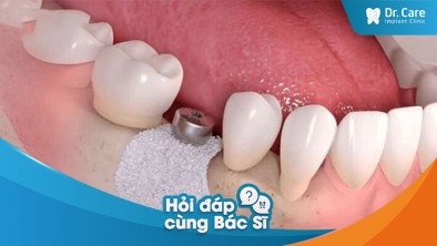 Mất răng lâu năm có ảnh hưởng đến quá trình lành thương và tích hợp xương của trụ Implant Hàn Quốc không?
