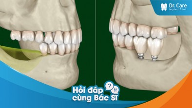 Mất răng lâu năm có ảnh hưởng răng còn lại không? Trồng trụ Implant Hàn Quốc có giải quyết đươc không?