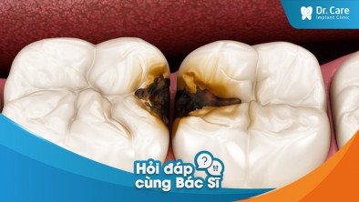 Bị sâu răng có ảnh hưởng đến quá trình trồng răng Implant với trụ Implant Hàn Quốc không?