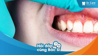 Viêm nha chu giai đoạn cuối ảnh hưởng đến khả năng trồng răng Implant như thế nào?