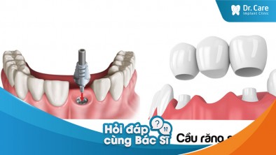 Trồng răng Implant có đau hơn so với bọc răng sứ không?