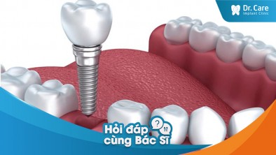 Phẫu thuật cắm trụ Implant răng hàm có đau không?