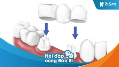 Dùng cầu răng sứ thay cho răng bị mất liền kề, thay thế bằng trồng răng Implant có được không?