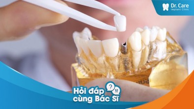 Quá trình thực hiện trồng răng giả cố định thường kéo dài bao lâu? 