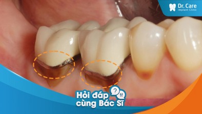 Bị bong cầu răng sứ ra và giải pháp thay thế nào tốt?