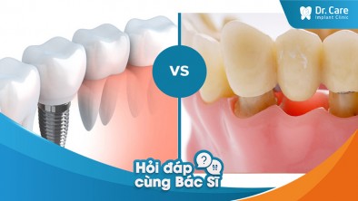 Trồng răng Implant có bị rớt răng giả ra ngoài như cầu răng sứ không?