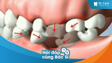 Mất răng số 6 có trồng răng sứ cố định được không?