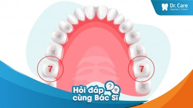 Mất răng số 7 hàm trên có trồng răng sứ cố định được không?