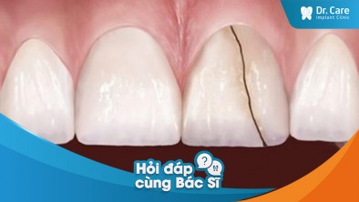 Cầu răng sứ bị hở và gây ra tình trạng nứt chân răng có sao không?
