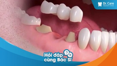 Tại sao cầu răng sứ có thể dẫn đến tình trạng mất răng toàn hàm?