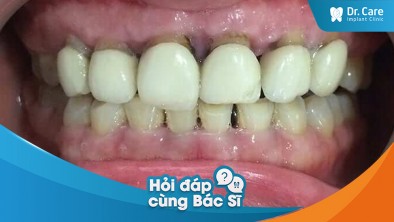 Những dấu hiệu nhận biết cầu răng sứ đang tác động gây ảnh hưởng đến sức khỏe răng miệng?
