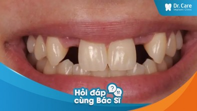 Mất răng số 2 có trồng răng sứ cố định được không?