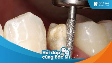 Có thể mất luôn răng thật do sử dụng cầu răng sứ lâu năm không?
