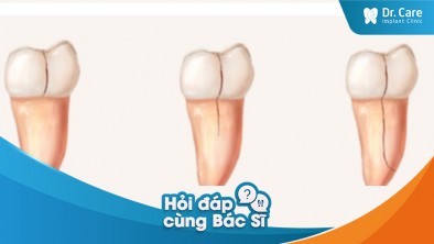 Răng thật có bị nứt dọc thân răng do sử dụng cầu răng sứ lâu năm không?