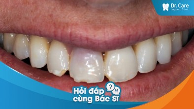 Răng thật có bị mẻ do sử dụng cầu răng sứ không?