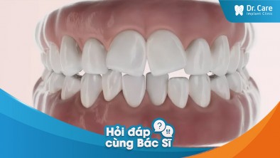 Răng bị nghiêng sau 1 thời gian sử dụng cầu răng sứ có sao không?
