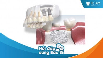 [Hỏi đáp bác sĩ] - Trồng răng Implant có đau không nếu phải ghép xương hàm?