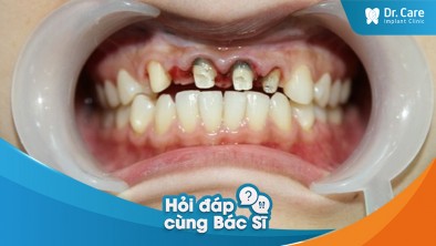 [Hỏi đáp bác sĩ] Sau khi mài răng bọc sứ 1 thời gian, bị viêm nướu răng, nguyên nhân là gì?