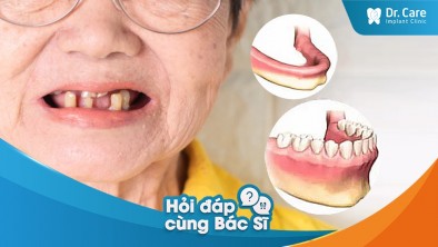 Trồng răng giả nguyên hàm cho người mất răng lâu năm được không?