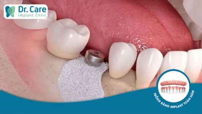 Trồng răng Implant khi bị tiêu xương có phức tạp không?