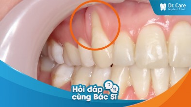 [Hỏi đáp bác sĩ] - Nướu răng bị tụt sau khi mài răng bọc sứ, nguyên nhân do đâu?