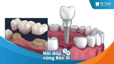 [Hỏi đáp bác sĩ] - Vì sao trồng răng Implant có thể khắc phục được tình trạng mất răng do mài răng bọc sứ?