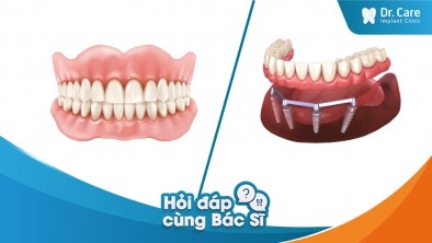 [Hỏi đáp bác sĩ] - So sánh ưu và nhược điểm của răng giả tháo lắp nguyên hàm và trồng răng Implant nguyên hàm