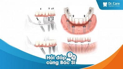 [Hỏi đáp bác sĩ] Địa chỉ trồng răng giả nguyên hàm uy tín ở Sài Gòn