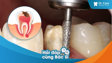 [Hỏi đáp bác sĩ] - Bị áp xe răng sau khi mài răng bọc sứ, nguyên nhân do đâu?