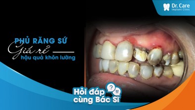 [Hỏi đáp bác sĩ] - Những bệnh lý răng miệng thường gặp sau khi sử dụng dịch vụ bọc răng sứ giá rẻ
