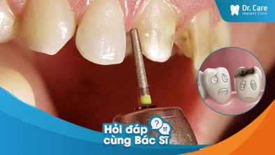 [Hỏi đáp bác sĩ] - Tại sao sau khi mài răng bọc sứ, bị sâu răng ở vùng răng bị mài?