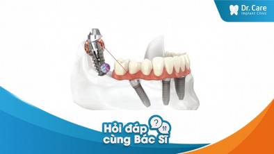 [Hỏi đáp bác sĩ] Mất răng lâu năm có ảnh hưởng đến quá trình lành thương và tích hợp của trụ Implant Thụy Sĩ không?